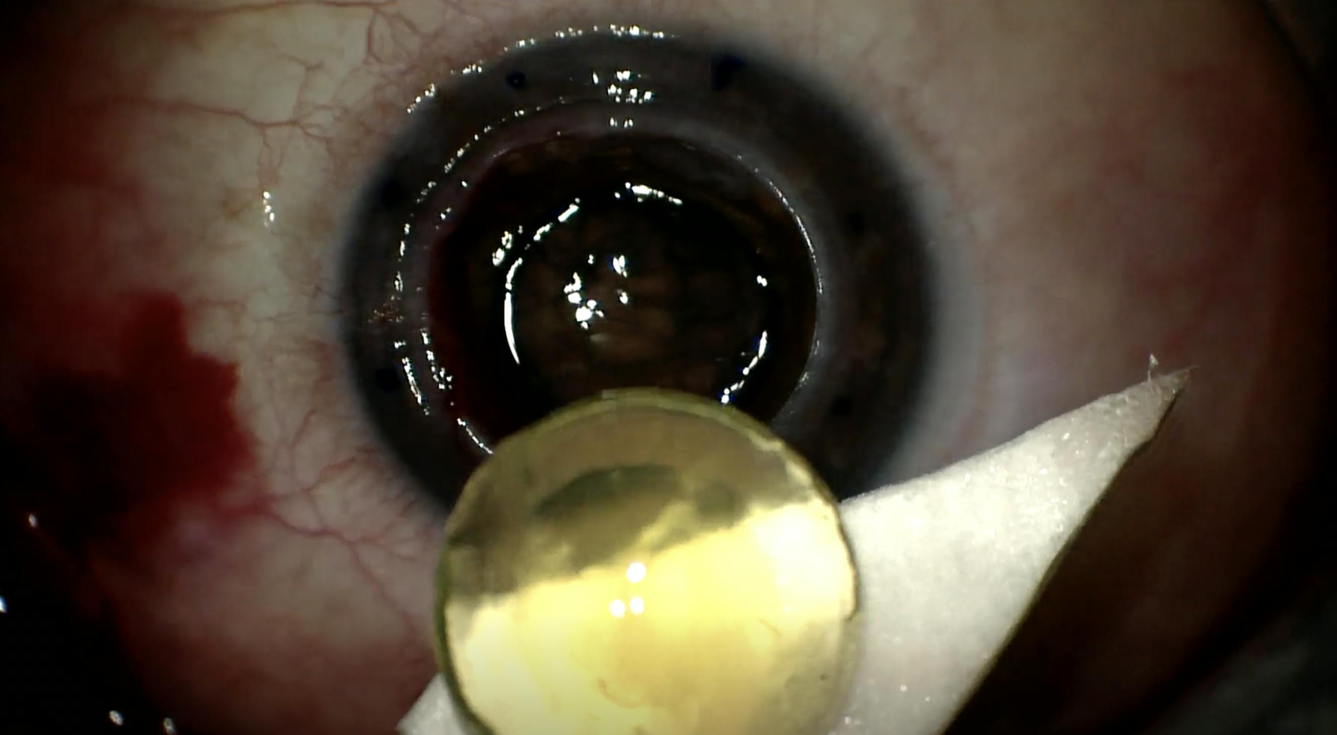 Keratoplasty and Extracapsular Cataract Extraction Eyetube
